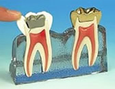 dente fracturado